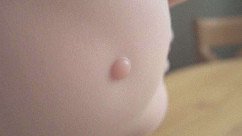 Kaszaki na twarzy – objawy, przyczyny i metody leczenia